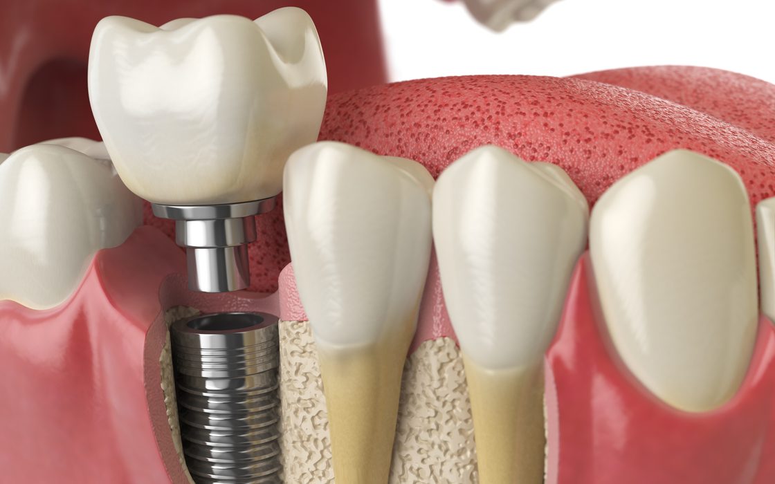 Rappresentazione in sezione di un impianto dentale inserito nell'osso mascellare, con moncone e corona